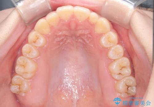 【インビザライン】八重歯を治したいの治療後