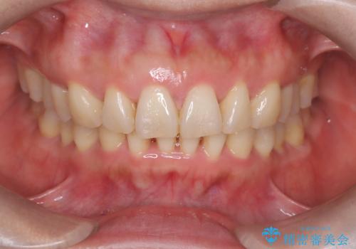 【インビザライン】出っ歯を治したいの治療後