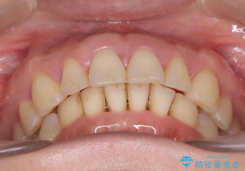 【インビザライン】出っ歯を治したいの治療後