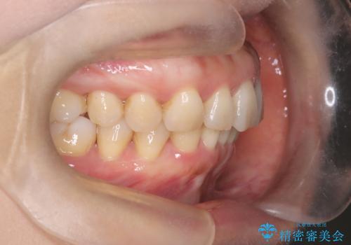 【インビザライン】出っ歯を治したいの治療後