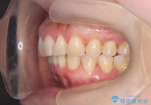 【インビザライン】出っ歯を治したいの治療後