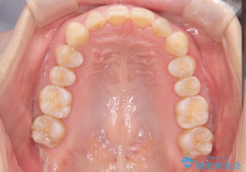 【インビザライン】出っ歯を治したいの治療後