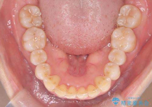 【インビザライン】出っ歯を治したいの治療後