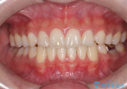 【抜歯矯正】犬歯抜歯による矯正。八重歯を治したいの症例 治療後