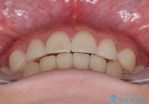 【抜歯矯正】犬歯抜歯による矯正。八重歯を治したい。の治療後