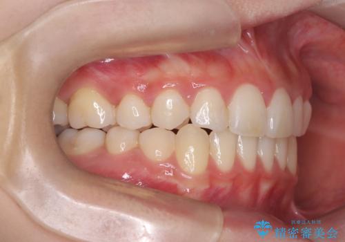 【抜歯矯正】犬歯抜歯による矯正。八重歯を治したいの治療後