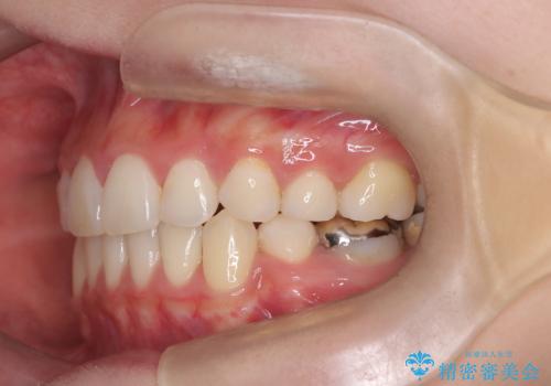【抜歯矯正】犬歯抜歯による矯正。八重歯を治したい。の治療後
