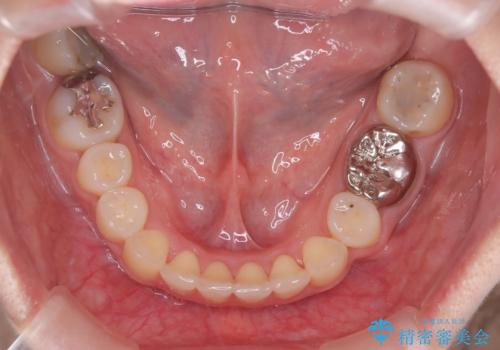 【抜歯矯正】犬歯抜歯による矯正。八重歯を治したいの治療後