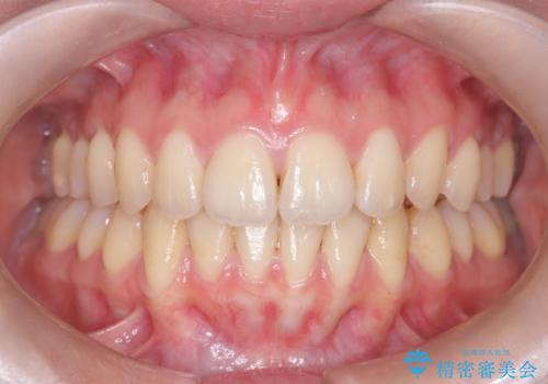 【インビザライン】アンカースクリューを用いた遠心移動の治療後