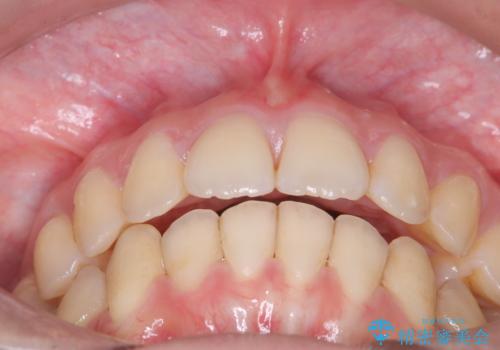 【インビザライン】アンカースクリューを用いた遠心移動の治療後