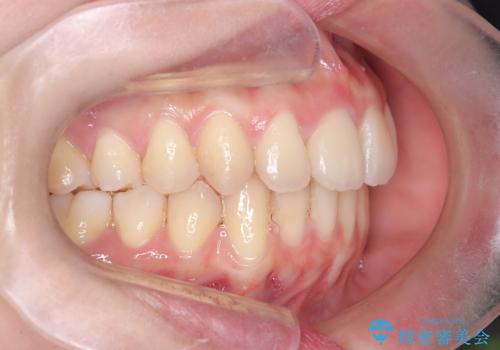 【インビザライン】アンカースクリューを用いた遠心移動の治療後