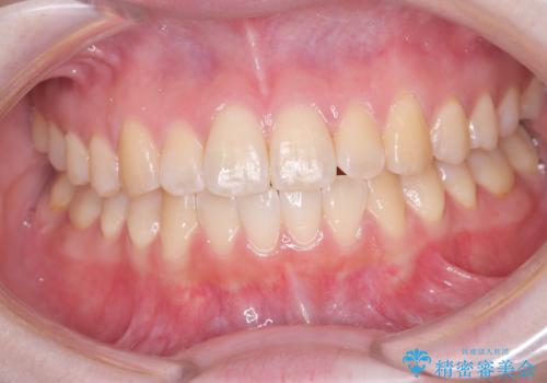 【インビザライン】オープンバイト。凸凹を治したいの症例 治療後