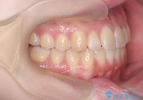 【インビザライン】オープンバイト。凸凹を治したいの治療後