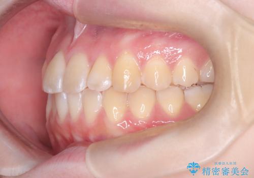 【インビザライン】オープンバイト。凸凹を治したいの治療後