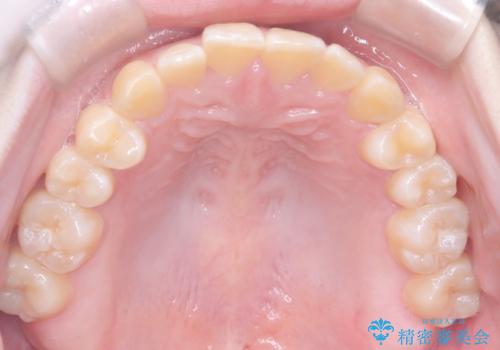 【インビザライン】オープンバイト。凸凹を治したいの治療後