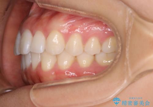 インビザライン矯正 前歯のすきっ歯を治したいの治療後