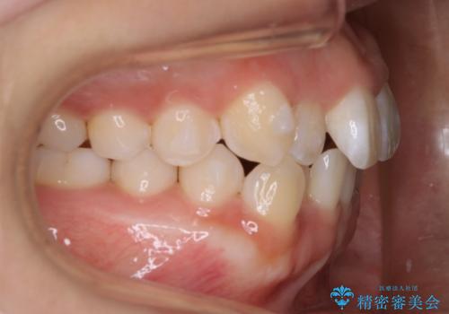 インビザライン矯正 短期間でがたつきのない歯並びに!の治療中
