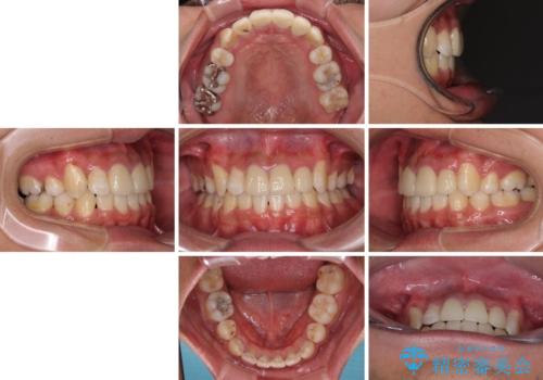 デコボコと変色した前歯　抜歯矯正と審美歯科治療の治療後
