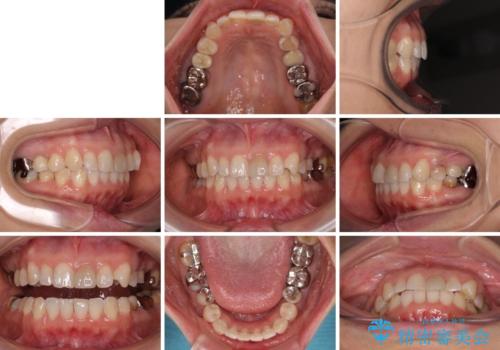 気になる下顎歯列のみをインビザラインで部分矯正の治療後