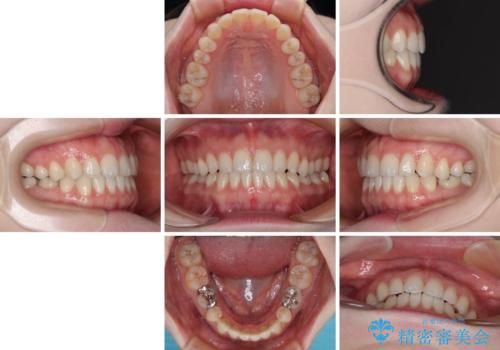 すきっ歯をインビザラインできれいな歯並びに改善の治療後