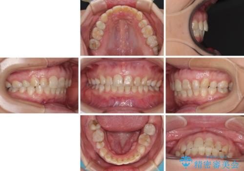 ハーフリンガルで歯列をきれいに セラミック治療で気になる銀歯も自然な色にの治療後