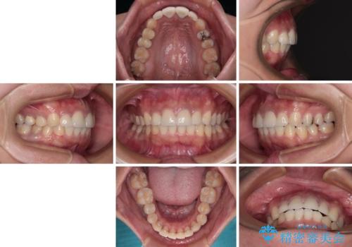 歯列から飛び出た歯 ワイヤー矯正で整った歯列にの治療後