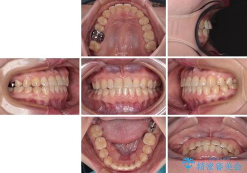 反対咬合を治したい ワイヤー装置で一気に咬み合わせを改善の治療後