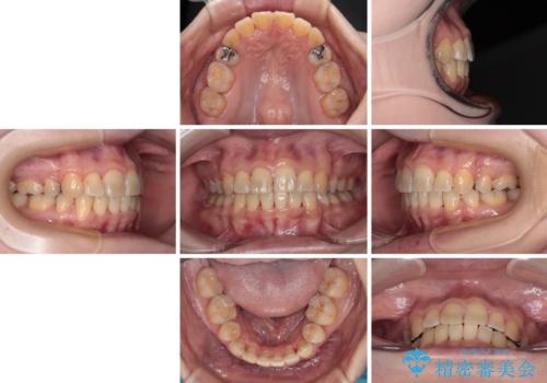 治療途中で帰国 装置をつけた状態を継続して矯正治療の治療後
