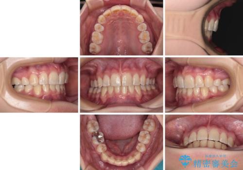 【モニター】出っ歯と八重歯 抜歯矯正でスッキリとした口元にの治療後