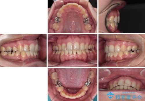 しゃくれて口が閉じられない ワイヤー装置での抜歯矯正の治療後