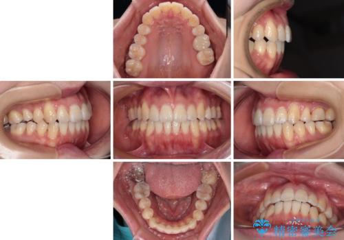 八重歯と開咬の抜歯矯正 ワイヤー装置を併用したインビザライン矯正治療の治療後