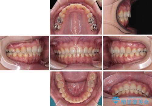 外科手術が必要と言えるほど突出した前歯 長期間をかけた抜歯矯正の治療後