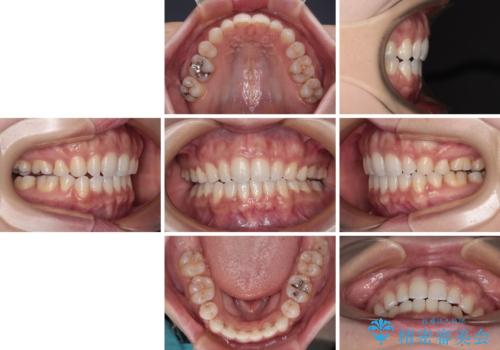 唇が閉じにくい ワイヤー装置での抜歯矯正の治療後