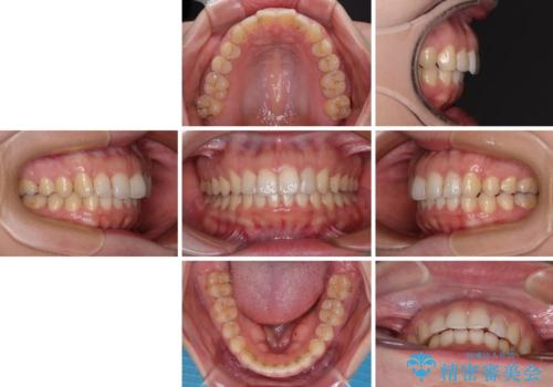 インビザライン矯正で前歯のデコボコを改善の治療後