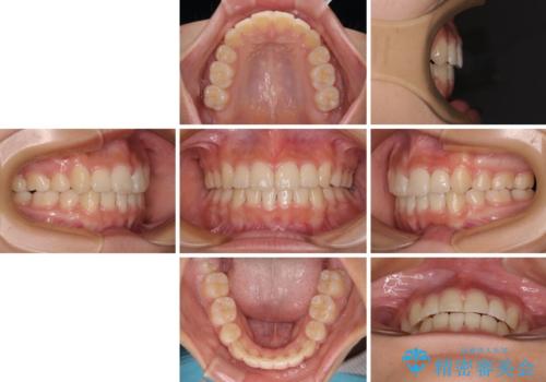 上顎骨幅が狭い 急速拡大装置を併用した抜歯矯正の治療後