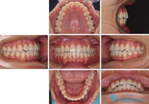 咬み合わせの乱れを改善 ワイヤー装置で楽々矯正治療の治療後