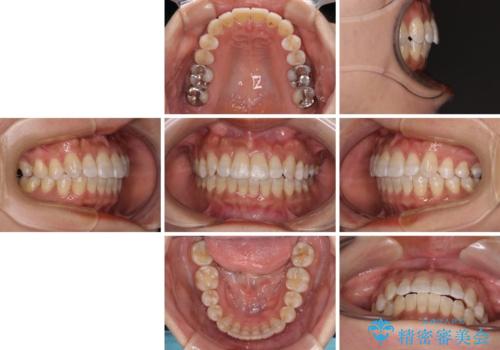 気になる八重歯 ワイヤー装置での非抜歯矯正の治療後