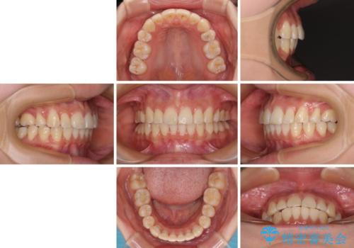 飛び出した前歯を引っ込めたい ワイヤー装置での抜歯矯正の治療後