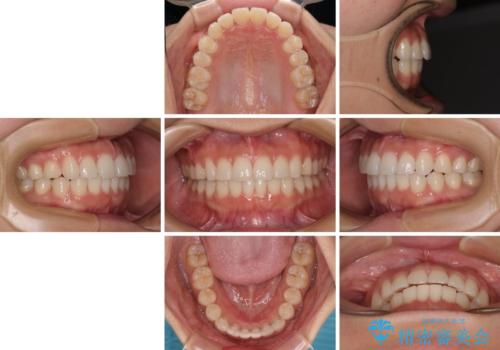 上下前歯のデコボコ ワイヤー装置で楽して改善の治療後