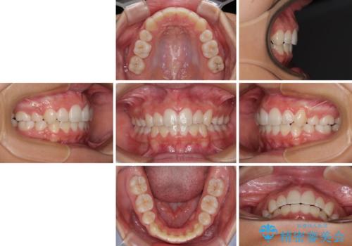 気がつくと唇があいてしまう ワイヤー装置での抜歯矯正の治療後