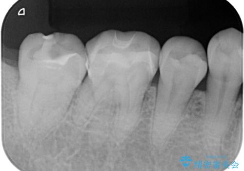 歯と歯の間に物がよく詰まるの治療後
