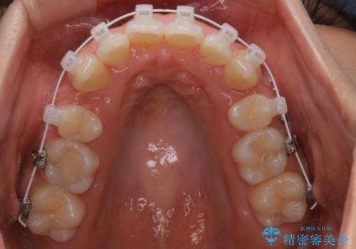 ワイヤー矯正　抜歯本数を最小限にし、八重歯のない歯並びに　の治療中