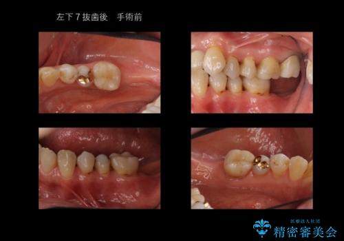 奥歯のインプラント 永くもつようにの治療前