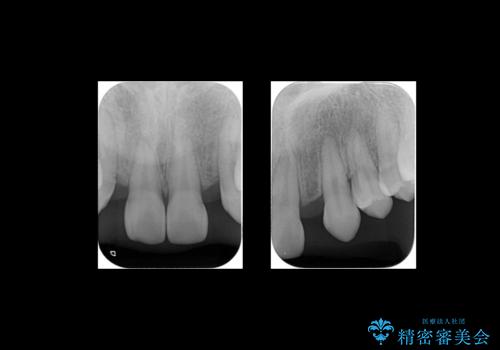 前歯のすきま 生まれつき歯が少ないのを治療の治療中