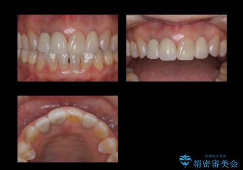 前歯のかぶせもののやり直し、根の治療もの治療後