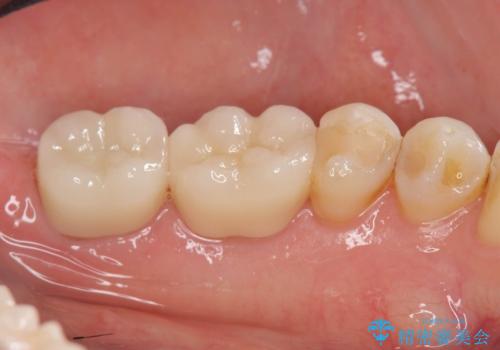 銀歯をセラミック治療で白くの治療後