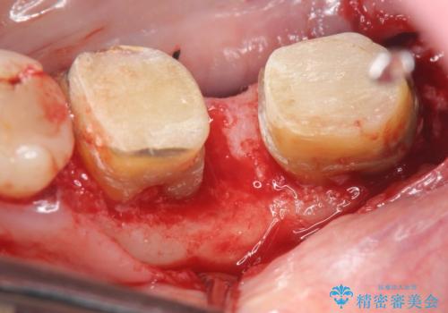 歯周病の歯を残すための再生治療の治療後