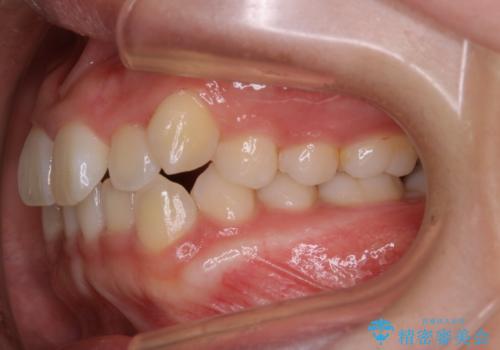インビザライン矯正 短期間でがたつきのない歯並びに!の治療前