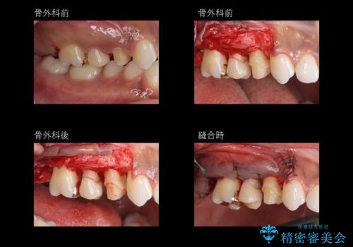 全体的な虫歯治療の治療中