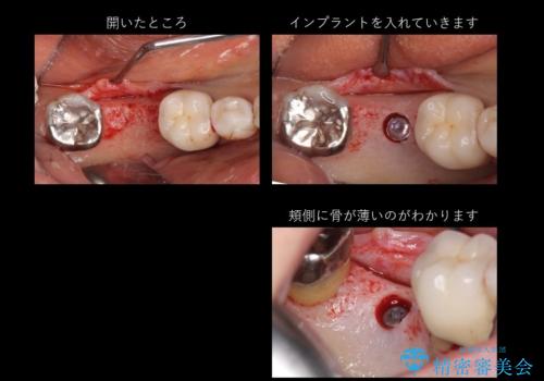 60代女性 奥歯のインプラント の治療中